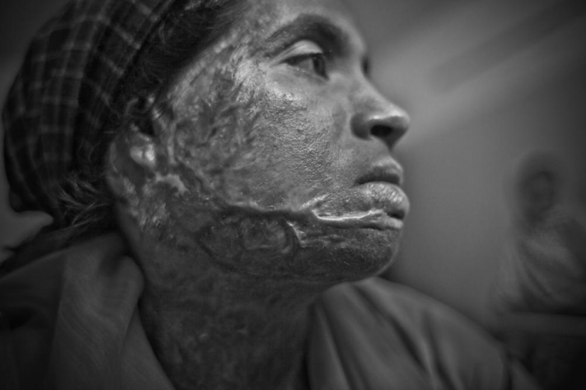 La educación de ácido en Bangladesh