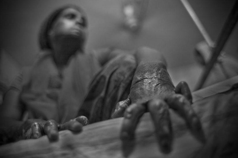 The education of acid in Bangladesh