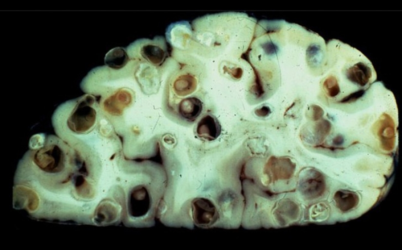 10 most terrifying parasites that can live in the human body