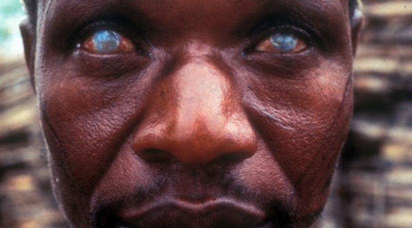 10 más terroríficos de parásitos que pueden vivir en el cuerpo humano