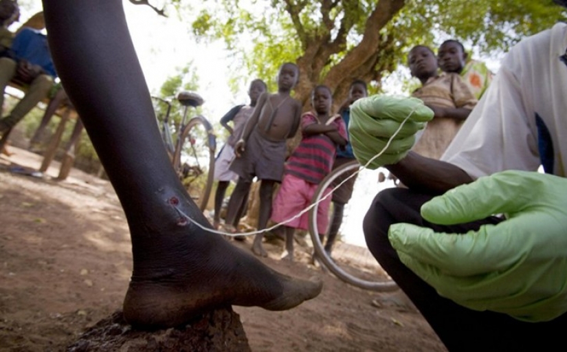 10 más terroríficos de parásitos que pueden vivir en el cuerpo humano