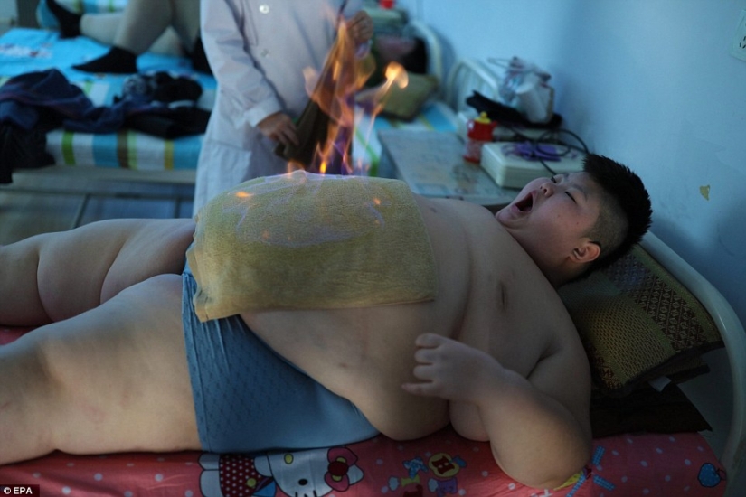 11-year-old Chinese man weighing 150 pounds trying to lose weight with the help of fire