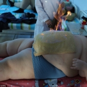 11-year-old Chinese man weighing 150 pounds trying to lose weight with the help of fire