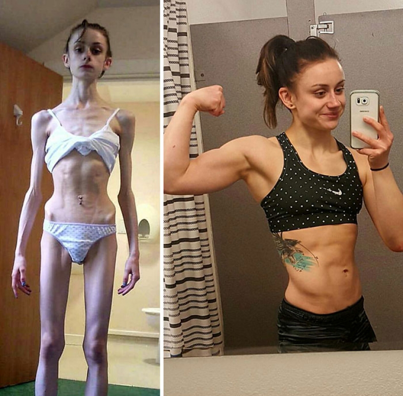 Antes y después: 20 ejemplos de personas que lograron superar la anorexia