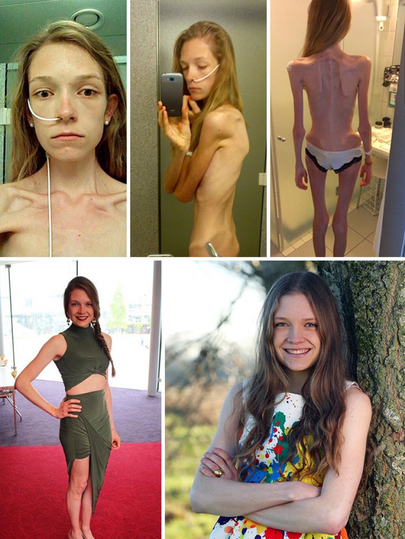 Before and after: 20 examples of people who managed to overcome anorexia Before and after: 20 examples of people who managed to overcome anorexia