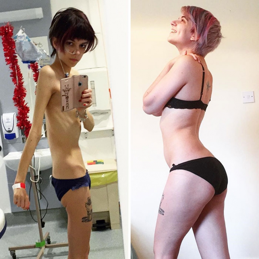 Before and after: 20 examples of people who managed to overcome anorexia Before and after: 20 examples of people who managed to overcome anorexia