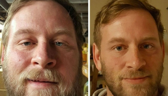 Before and after: how to change the appearance of the person who stops drinking