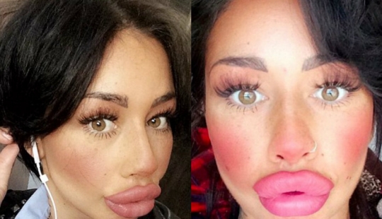 British albóndigas: una madre soltera de Liverpool ha pasado casi 2 mil libras para un intercambio de los labios y no puede parar