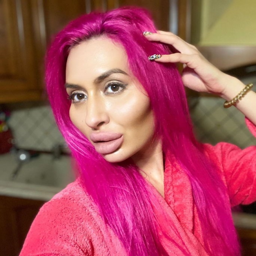 Cheeks-barrels: from Kiev itself injects fillers to be special