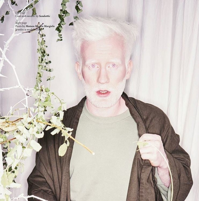 Cómo son los albinos diferentes nacionalidades y razas