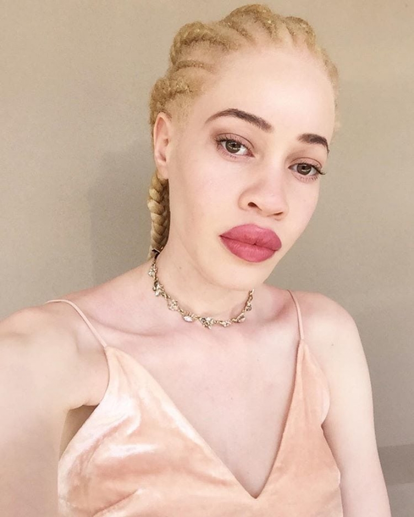 Cómo son los albinos diferentes nacionalidades y razas