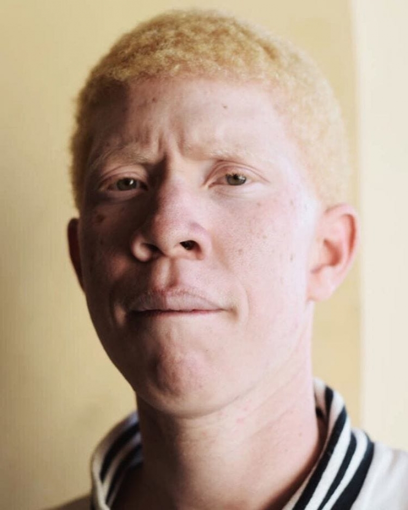 Cómo son los albinos diferentes nacionalidades y razas