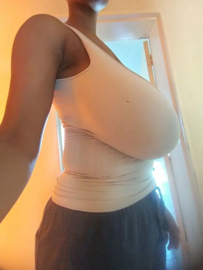 Como la piedra de alma: la vida de una niña con 13 tamaño de la mama ha cambiado drásticamente después de la cirugía de reducción de busto