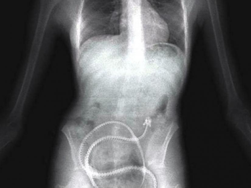 El peor de los artículos que han encontrado alguna vez en un estómago humano