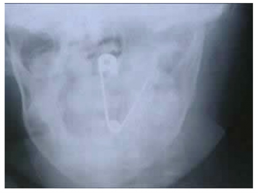 El peor de los artículos que han encontrado alguna vez en un estómago humano