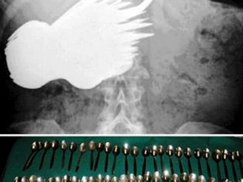 El peor de los artículos que han encontrado alguna vez en un estómago humano