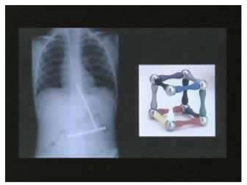 El peor de los artículos que han encontrado alguna vez en un estómago humano