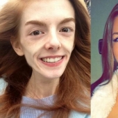 Girl with a weight of 29 kg defeated anorexia with chocolate