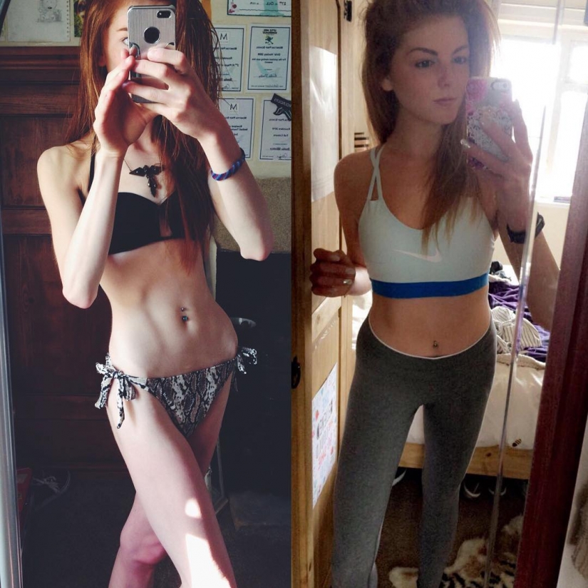 Girl with a weight of 29 kg defeated anorexia with chocolate Girl with a weight of 29 kg defeated anorexia with chocolate