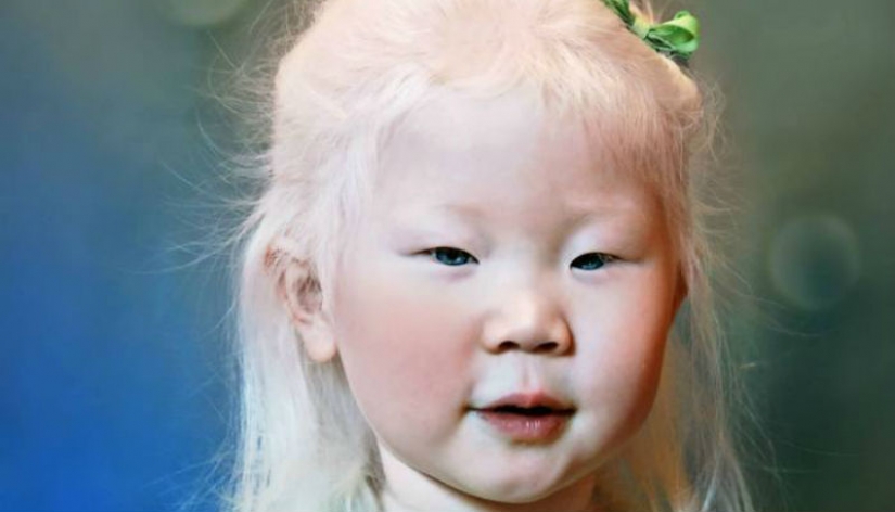 How are albinos different nationalities and races