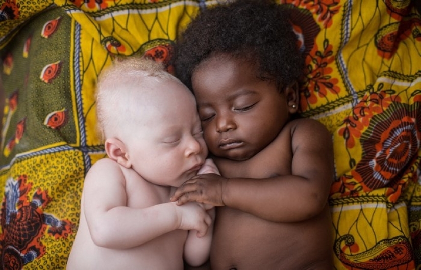 How are albinos different nationalities and races