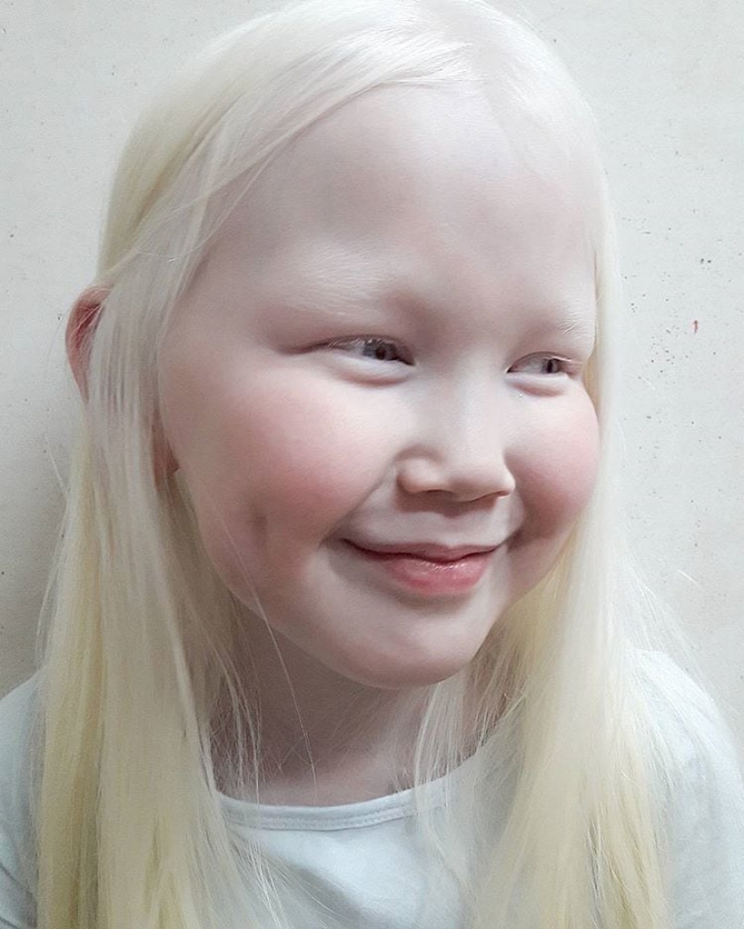How are albinos different nationalities and races