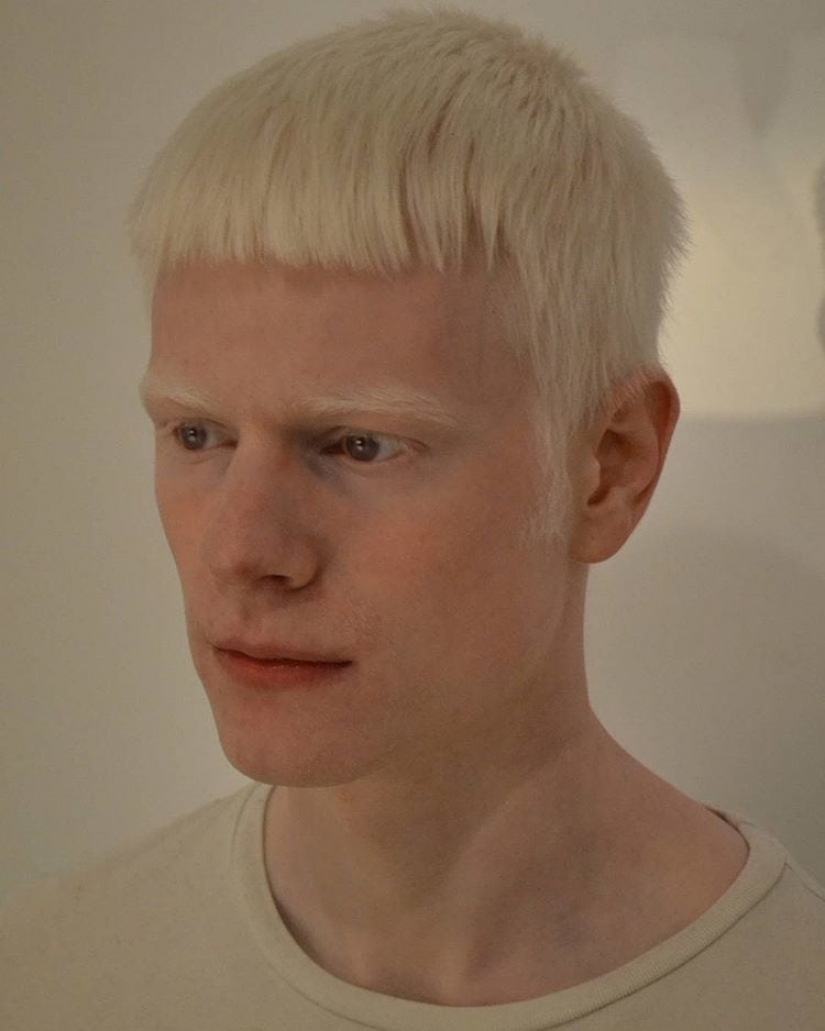 How are albinos different nationalities and races