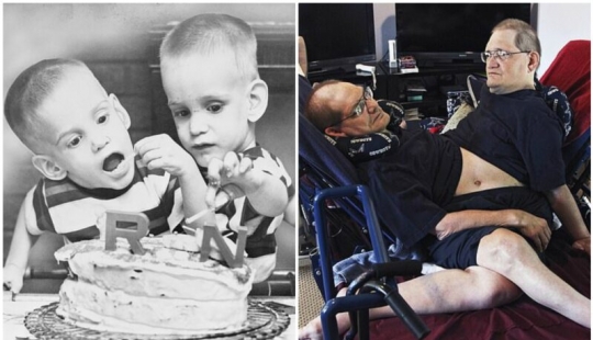 In the United States died the oldest conjoined twins Ronnie and Donnie Gelion