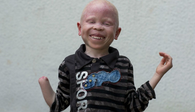 Los albinos de tanzania, cuyos cuerpos valen más que el oro Los albinos de tanzania, cuyos cuerpos valen más que el oro
