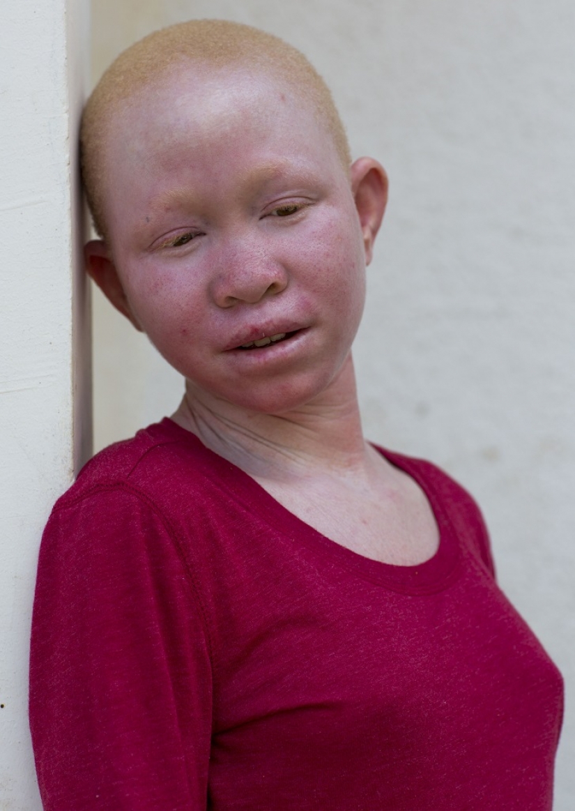 Los albinos de tanzania, cuyos cuerpos valen más que el oro Los albinos de tanzania, cuyos cuerpos valen más que el oro