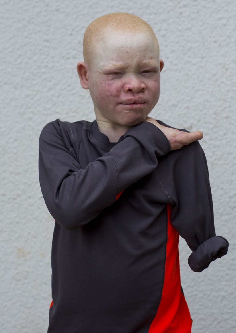 Los albinos de tanzania, cuyos cuerpos valen más que el oro Los albinos de tanzania, cuyos cuerpos valen más que el oro