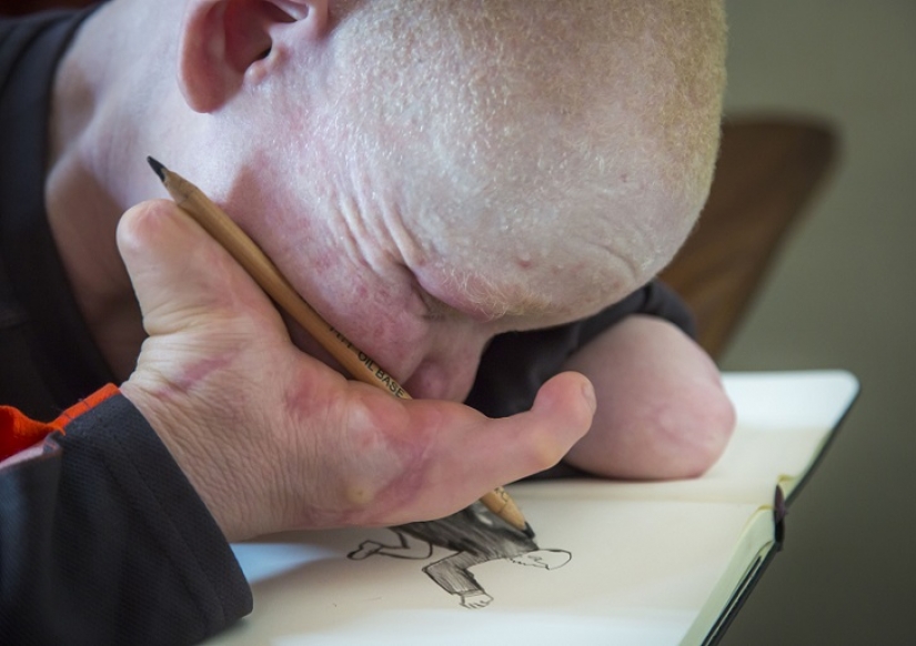 Los albinos de tanzania, cuyos cuerpos valen más que el oro Los albinos de tanzania, cuyos cuerpos valen más que el oro