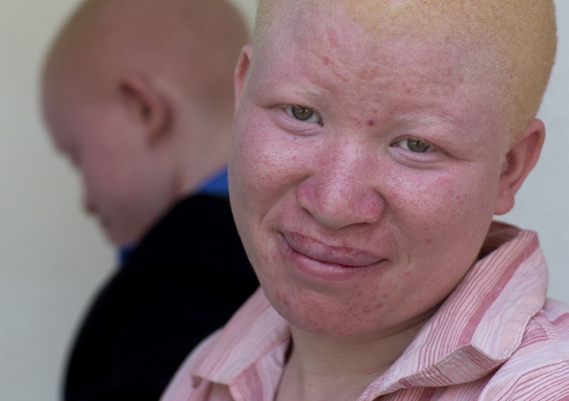 Los albinos de tanzania, cuyos cuerpos valen más que el oro Los albinos de tanzania, cuyos cuerpos valen más que el oro