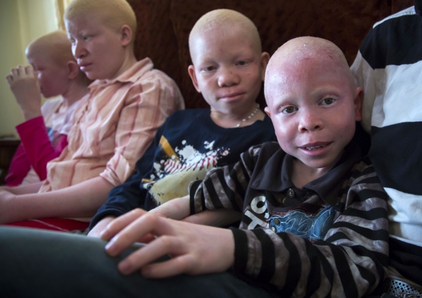 Los albinos de tanzania, cuyos cuerpos valen más que el oro Los albinos de tanzania, cuyos cuerpos valen más que el oro