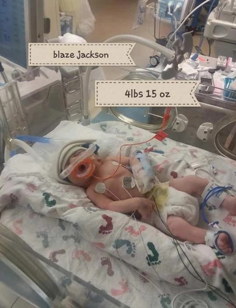 Non-random accident: a woman gave birth to triplets, not knowing about the pregnancy