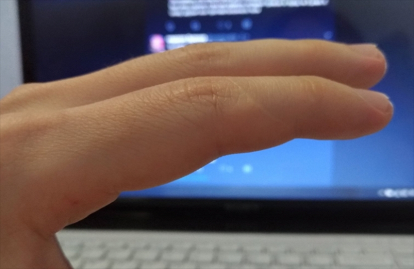 People suddenly realized that all of them have a scar on the index finger