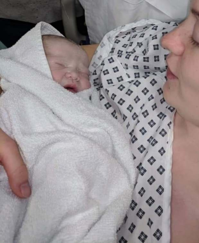 Rare syndrome: when the wife was pregnant, her husband was suffering from morning sickness and overeating