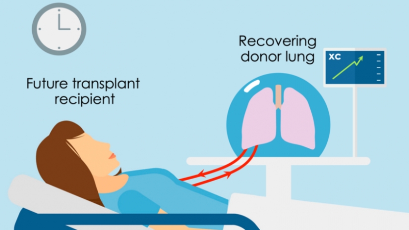 Scientists have restored the affected lungs of a person, connecting them to the swine Scientists have restored the affected lungs of a person, connecting them to the swine