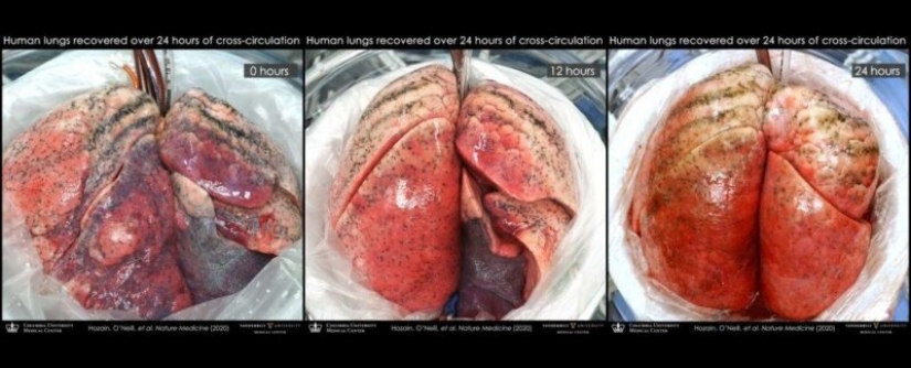 Scientists have restored the affected lungs of a person, connecting them to the swine Scientists have restored the affected lungs of a person, connecting them to the swine
