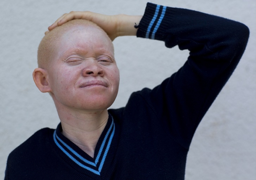 Tanzanian albinos, whose bodies are worth more than gold Tanzanian albinos, whose bodies are worth more than gold