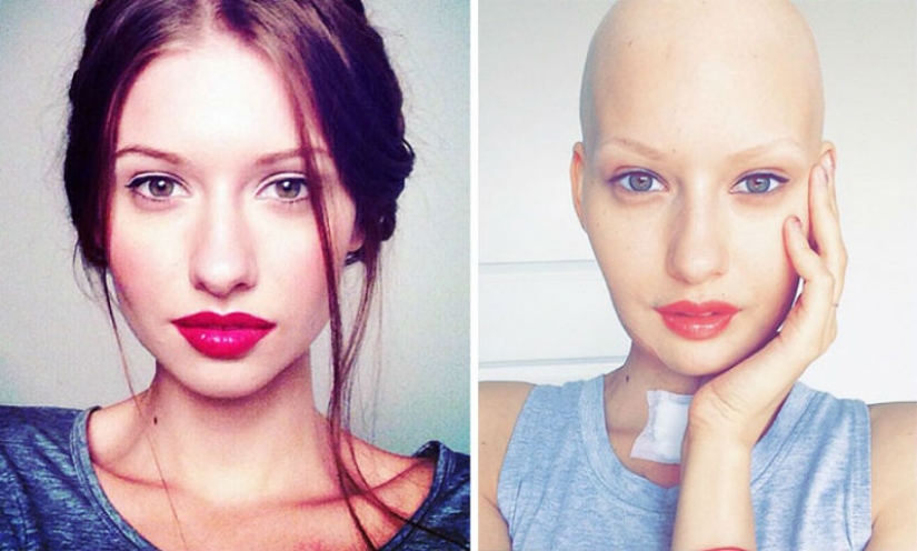 The doctors told the model to have an abortion after she has deleted 95% of the jaw to cancer — and that's what she did The doctors told the model to have an abortion after she has deleted 95% of the jaw to cancer — and that's what she did