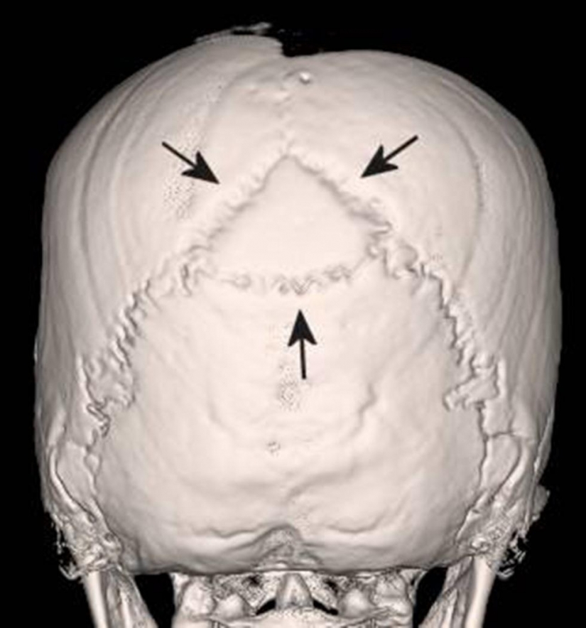 The Inca mummies of sacrificed children and women