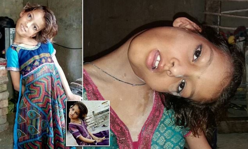 The world is at a right angle: neck 11-year-old Pakistani turned 90 degrees