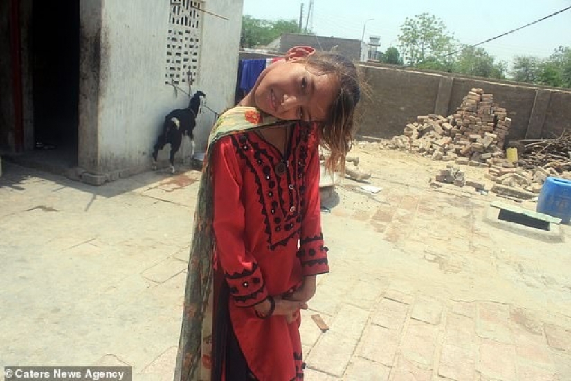 The world is at a right angle: neck 11-year-old Pakistani turned 90 degrees The world is at a right angle: neck 11-year-old Pakistani turned 90 degrees