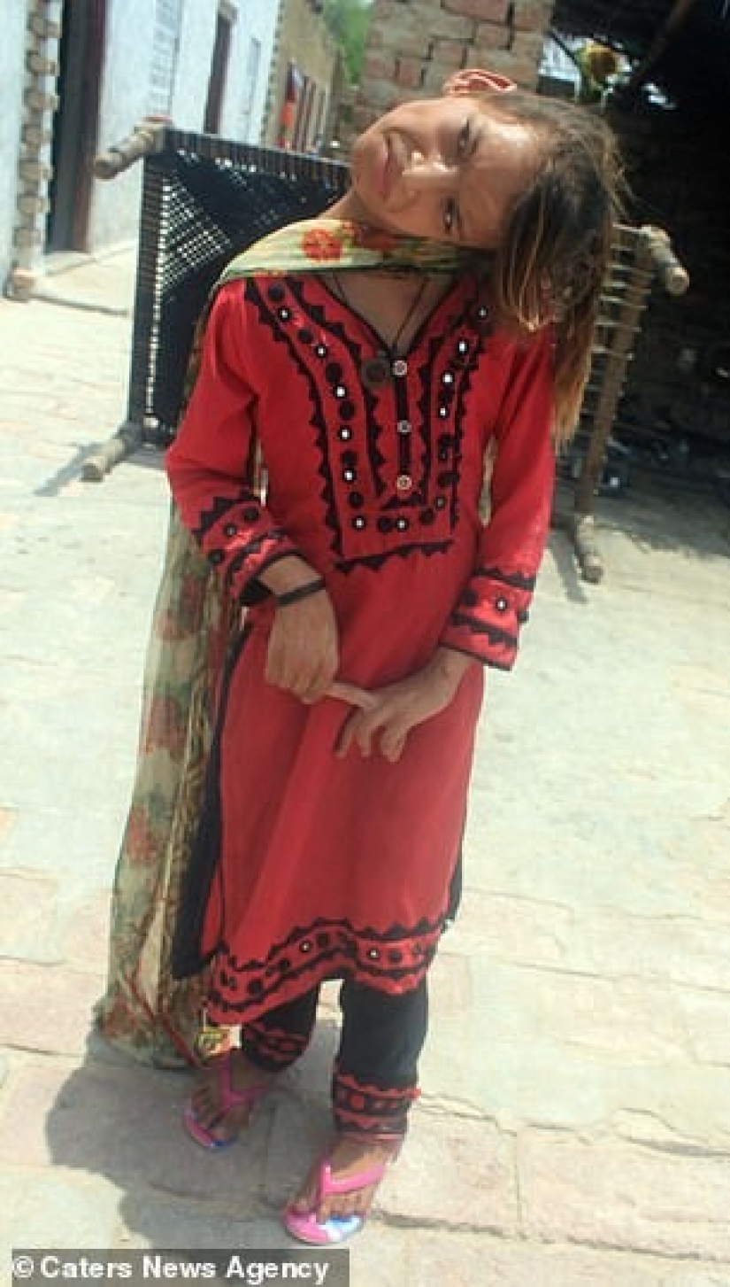 The world is at a right angle: neck 11-year-old Pakistani turned 90 degrees The world is at a right angle: neck 11-year-old Pakistani turned 90 degrees