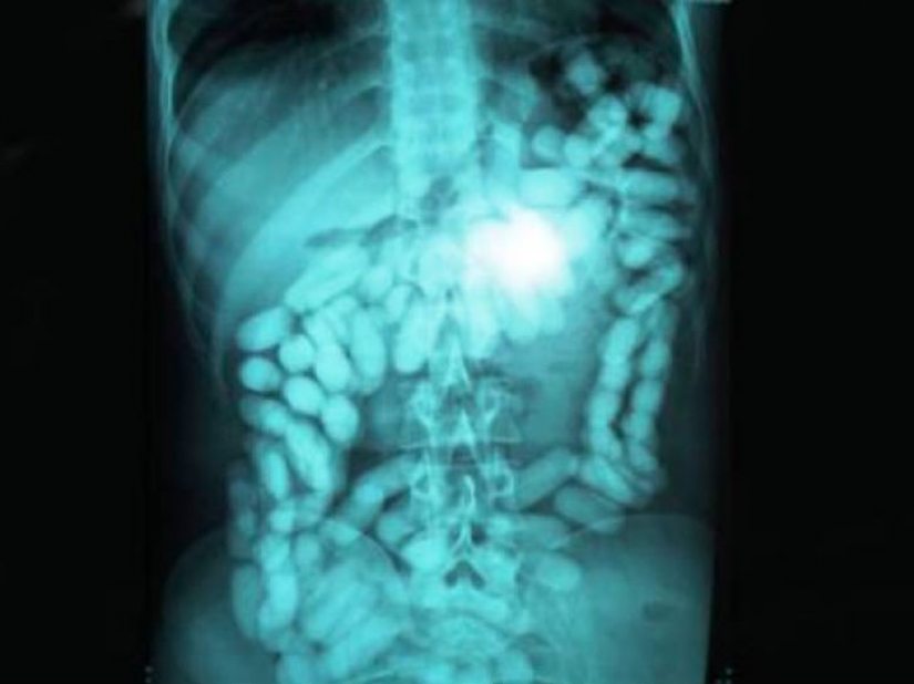 The worst items that have ever found in a human stomach