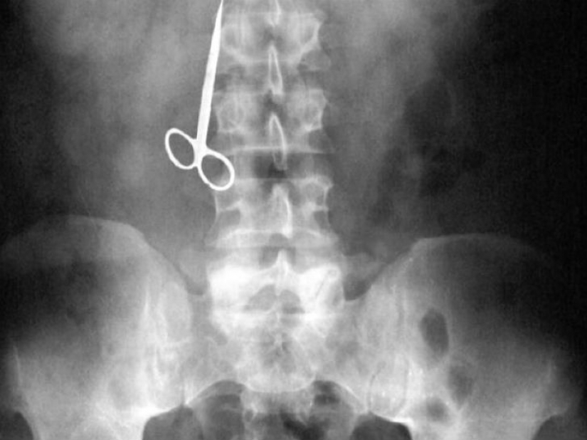 The worst items that have ever found in a human stomach