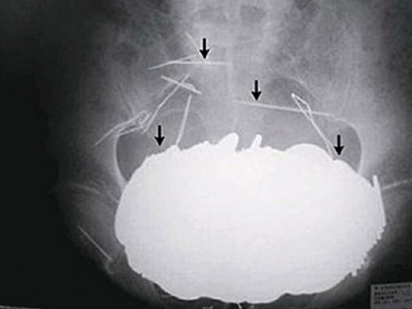 The worst items that have ever found in a human stomach