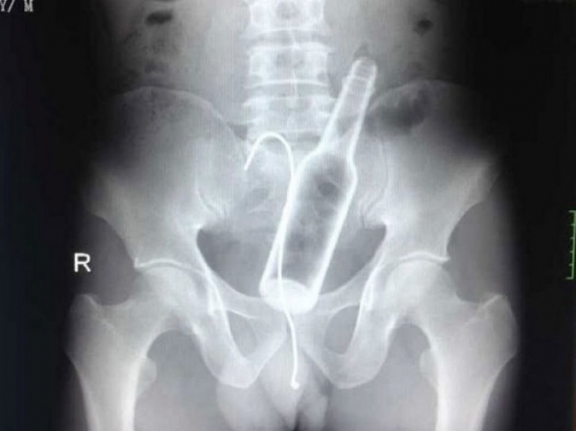 The worst items that have ever found in a human stomach