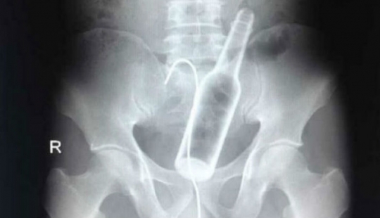 The worst items that have ever found in a human stomach